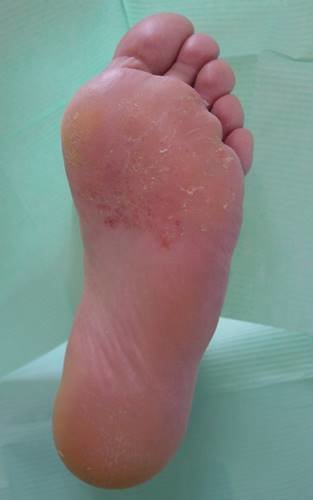 Micosis en la zona de la planta del pie, causada por la expansión de los hongos.